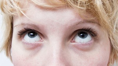 dark-circle-puffy-eyes