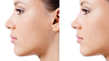 supra-tip-break-rhinoplasty-closeup